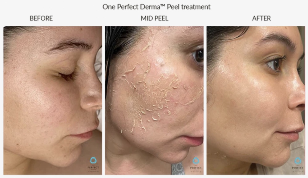 One Perfect Derma Peel treatment