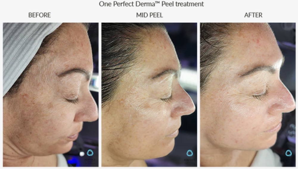 One Perfect Derma Peel treatment