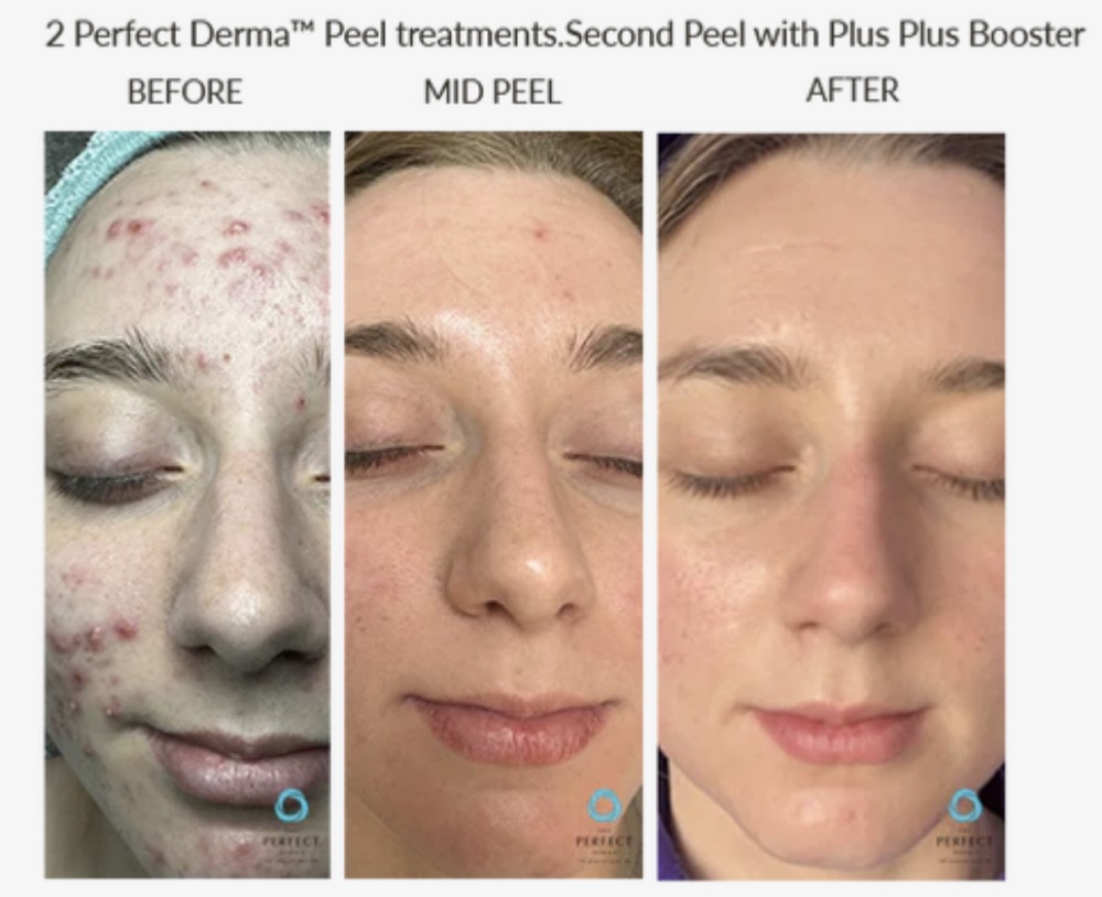 Two Perfect Derma Peel treatments, second peel with Plus Plus Booster